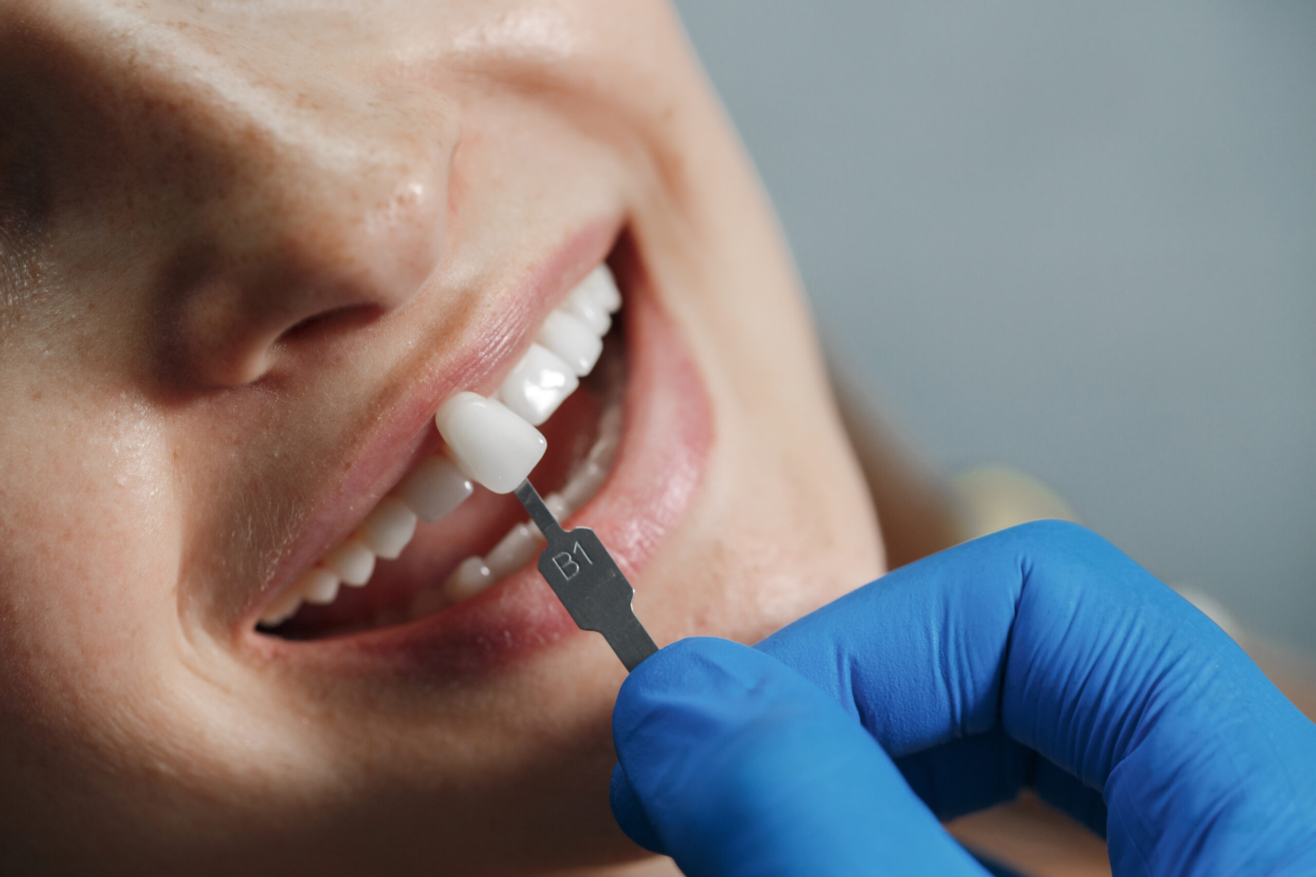 Dental implant procedure in Miami for smile restoration