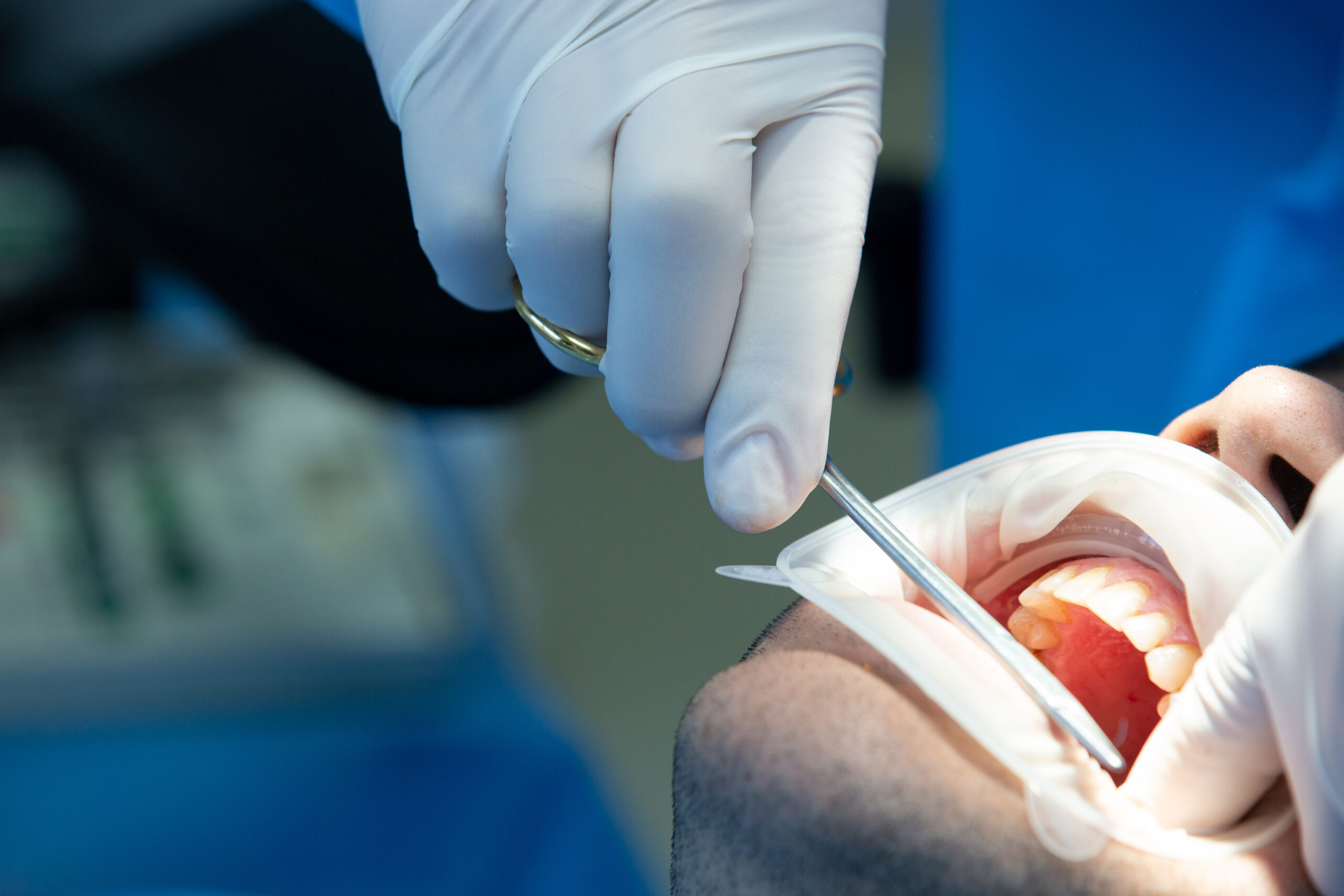 Dental implant procedure in Miami for smile restoration
