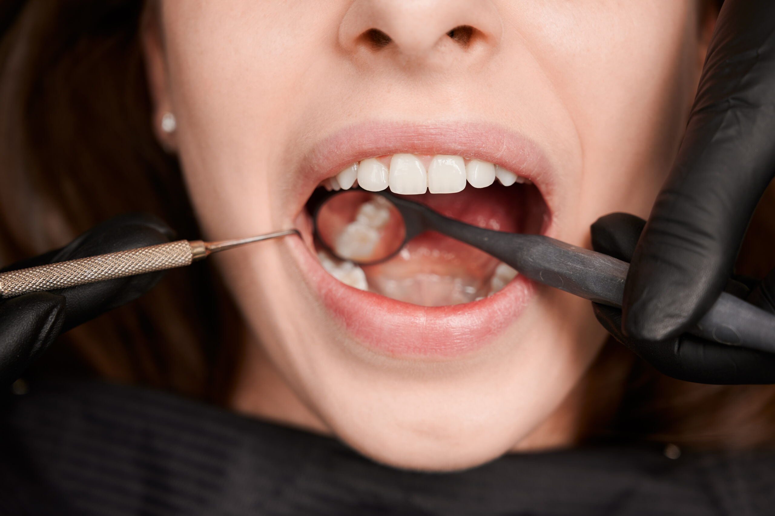Dental implant procedure in Miami for smile restoration